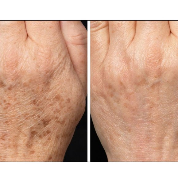 TCA Peel 15%_1oz Wrinkles, Age Spots, Crepey Skin - Picture 5 of 6